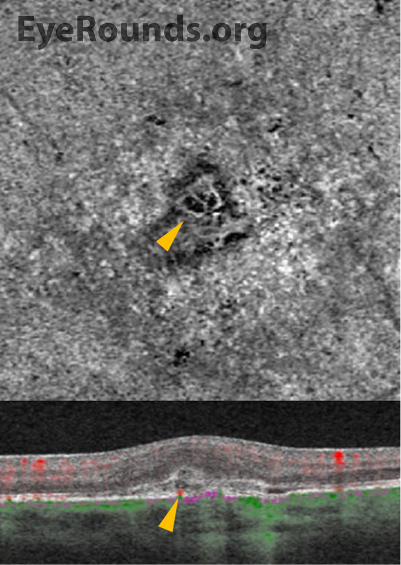 Cirrus Angioplex optical coherence tomography angiography, OS