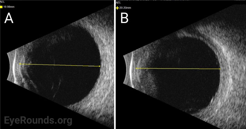 Axial eye length (AEL) measured using ultrasound. B) 20.20 mm OS.