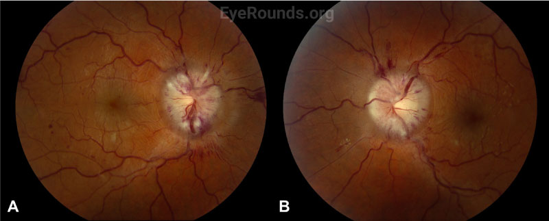 Color fundus photography, right (A) and left (B) eyes. Both eyes demonstrated grade IV optic disc edema with cotton wool spots, peripapillary hemorrhages, and retinal folds. In addition, scattered flame and dot-blot hemorrhages were seen in both eyes.