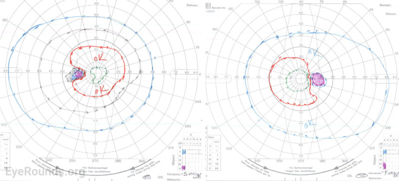 Goldmann Visual Field testing demonstrated an enlarged blind spot in both eyes.