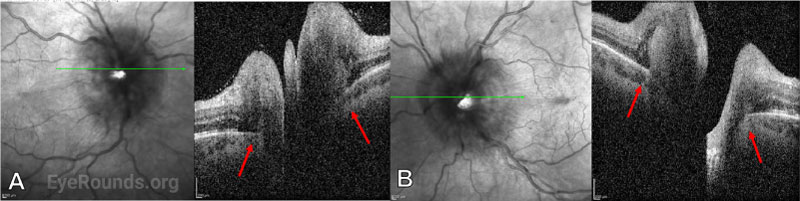 OCT of the right (A) and left (B) eyes following lumbar puncture and intitiation of treatment for Cryptococcal meningitis. 