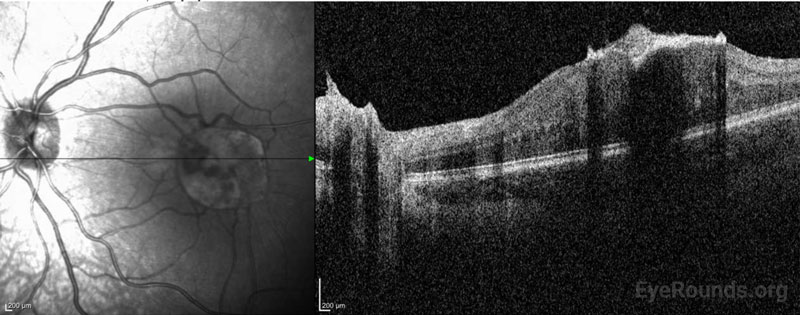 Color fundus photography, right (A) and left (B) eyes. Both eyes demonstrated grade IV optic disc edema with cotton wool spots, peripapillary hemorrhages, and retinal folds. In addition, scattered flame and dot-blot hemorrhages were seen in both eyes.