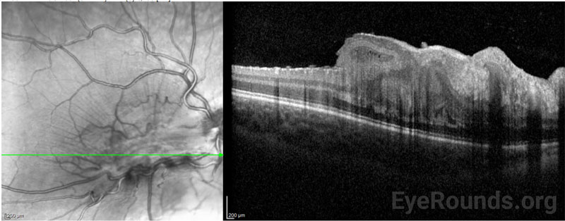 Color fundus photography, right (A) and left (B) eyes. Both eyes demonstrated grade IV optic disc edema with cotton wool spots, peripapillary hemorrhages, and retinal folds. In addition, scattered flame and dot-blot hemorrhages were seen in both eyes.