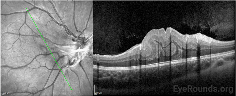 OCT of the right eye showed a central lesion with thickening and disorganization of the retinal layers and gliosis over the optic nerve.  There was no subretinal or intraretinal fluid..