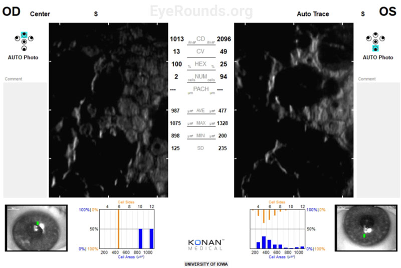 Specular microscopy of the right (OD) and left eye (OS) on presentation.  Most adults over age 40 have an endothelial cell density between 2000-3000 cells/mm2 with a uniform, hexagonal endothelial monoloayer.  In this patient, the endothelial cell density is significantly reduced in both eyes. Confluent guttae are seen in both eyes with variability in endothelial cell size (polymegethism) and shape (pleomorphism). 