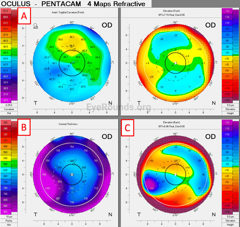 Scheimpflug tomography of the right eye on presentation (Oculus Pentacam), 4 Maps Refractive view. Imaging demonstrated (A) irregular contour; (B) increased corneal thickness, displacement of the thinnest point, and loss of isopach concentricity; and (C) focal areas of posterior depression, representing corneal edema. 