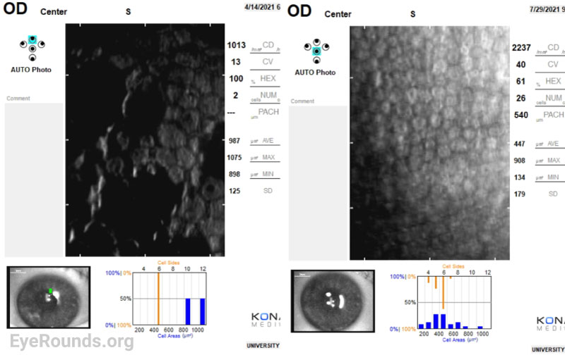 Specular microscopy of the right eye preoperatively (Left) and 3 months post-DMEK (Right). Preoperative specular microscopy shows confluence of the guttae and variability in corneal cell size (polymegathism) and shape (pleomorphism). In contrast, postoperative specular microscopy demonstrates a healthy, hexagonal endothelial cell morphology with improved endothelial cell count.  