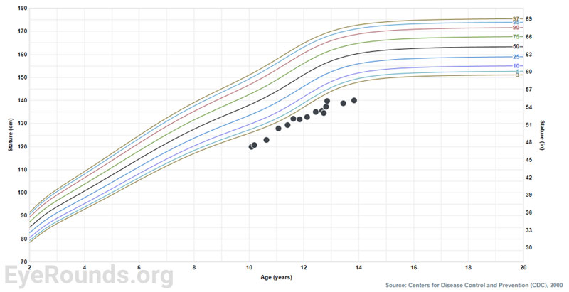 Growth chart of this patient demonstrating height measurements consistently below the 1st percentile.