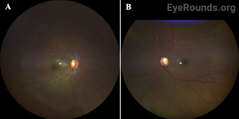 Fundus photos OD (A) and OS (B).