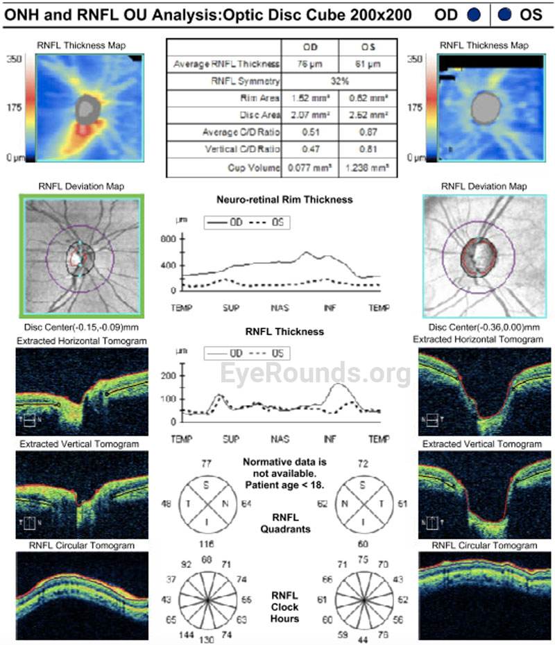 Optic nerve head and retinal nerve fiber layer OCT report. Age-normative data is unavailable for patients <18 years old.