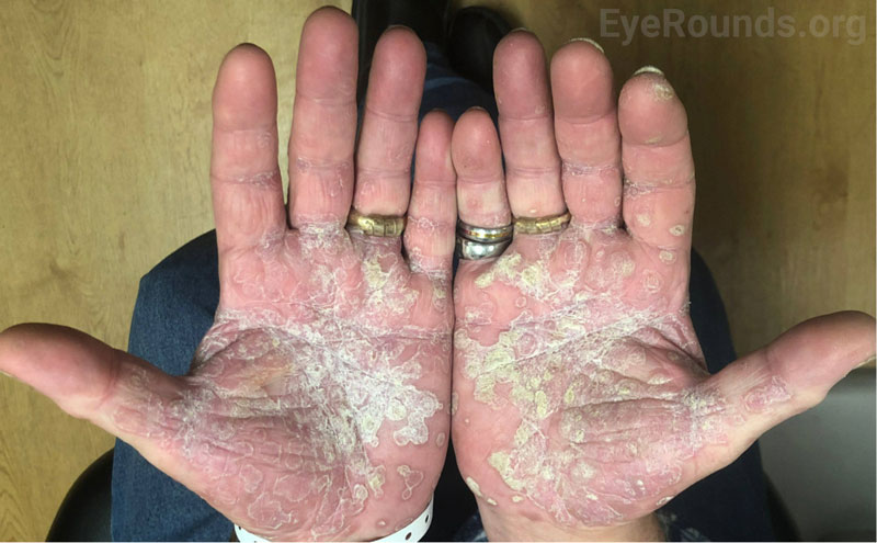 Nummular rash involving the bilateral palms. 