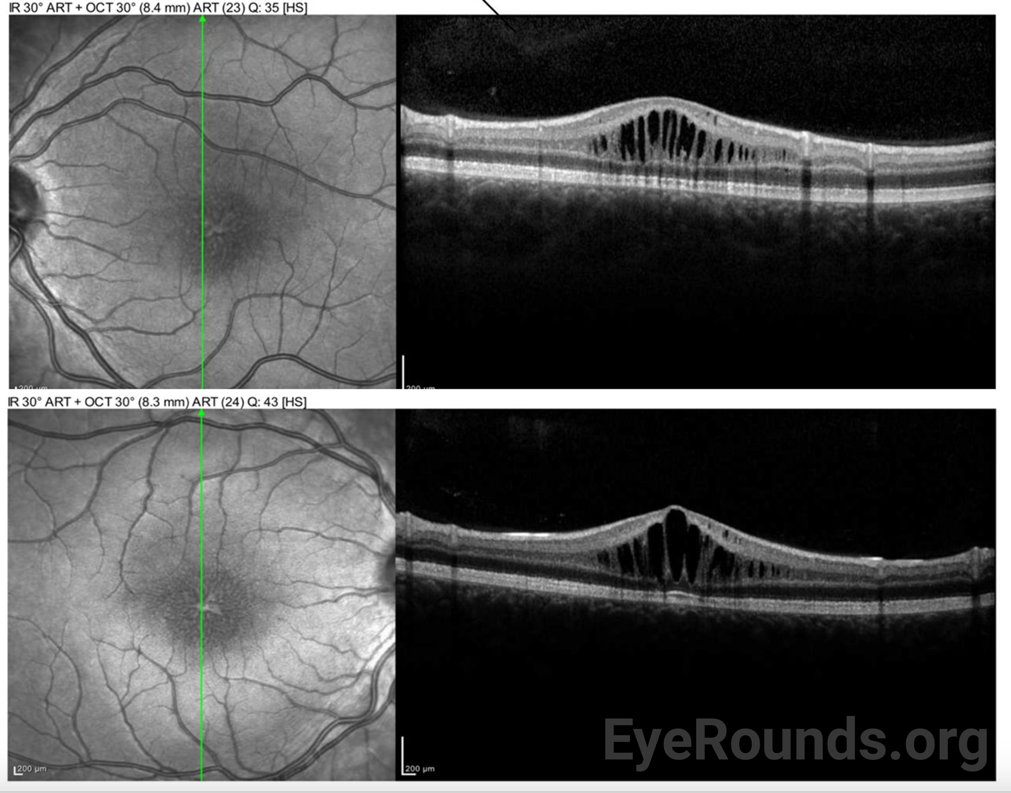 Bilateral OCT image demonstrates cystoid spaces located in the inner nuclear layer, separating inner and outer plexiform layers.