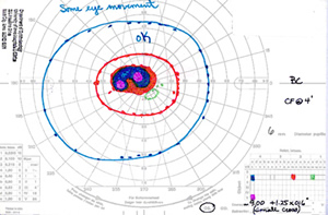 cecocentral scotoma