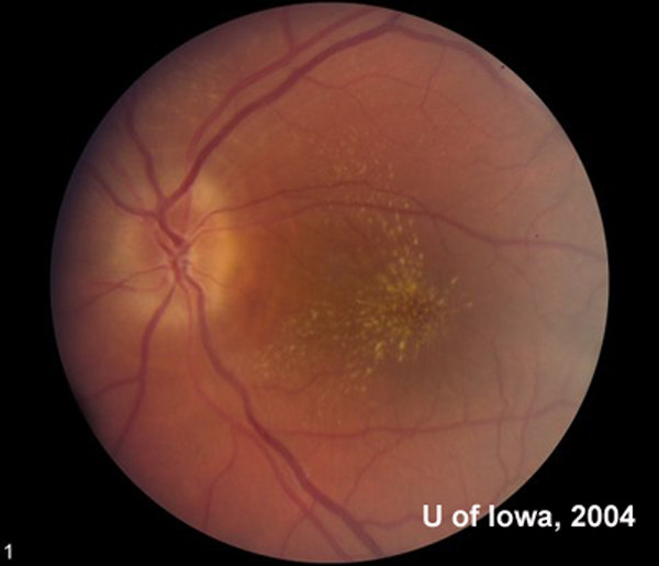 macular star