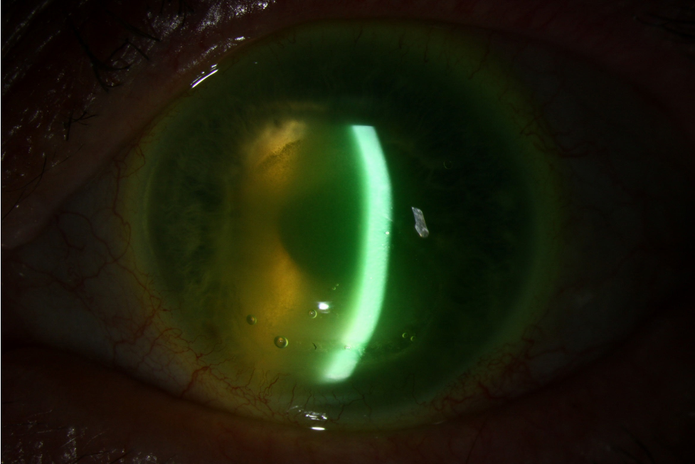 Large central epithelial defect with ring infiltrate, diffuse edema, and haze.