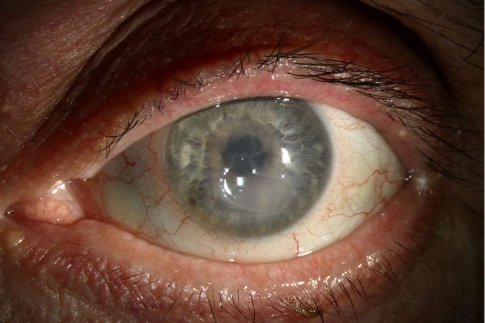 Slit lamp photograph of the left eye four months after presentation to our clinic. A 6.5 x 5.5 mm geographic corneal ulcer with heaped edges.