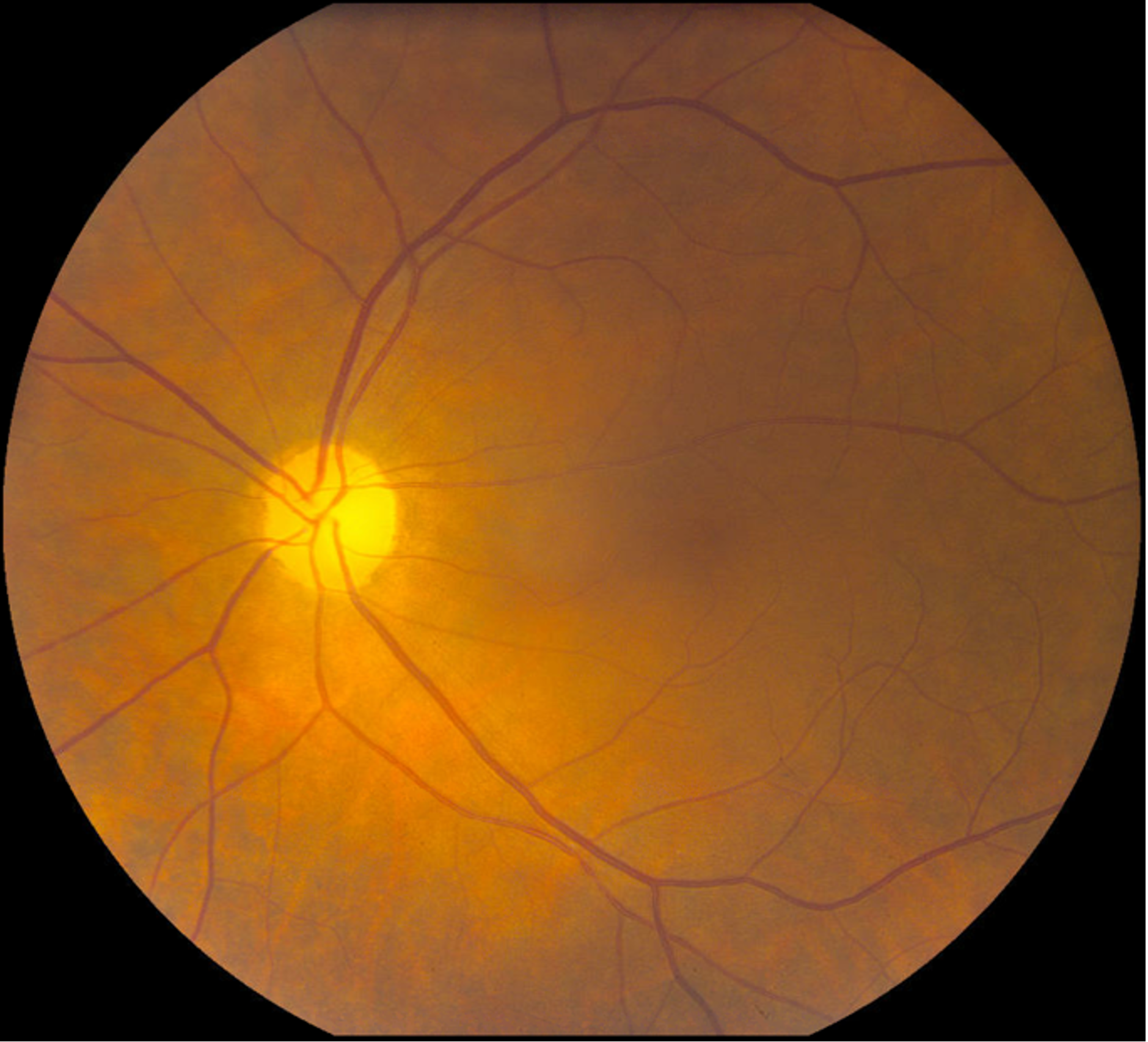 Color fundus photography of OD (left) and OS (right) showing bilateral optic nerve pallor with mild arteriolar narrowing.