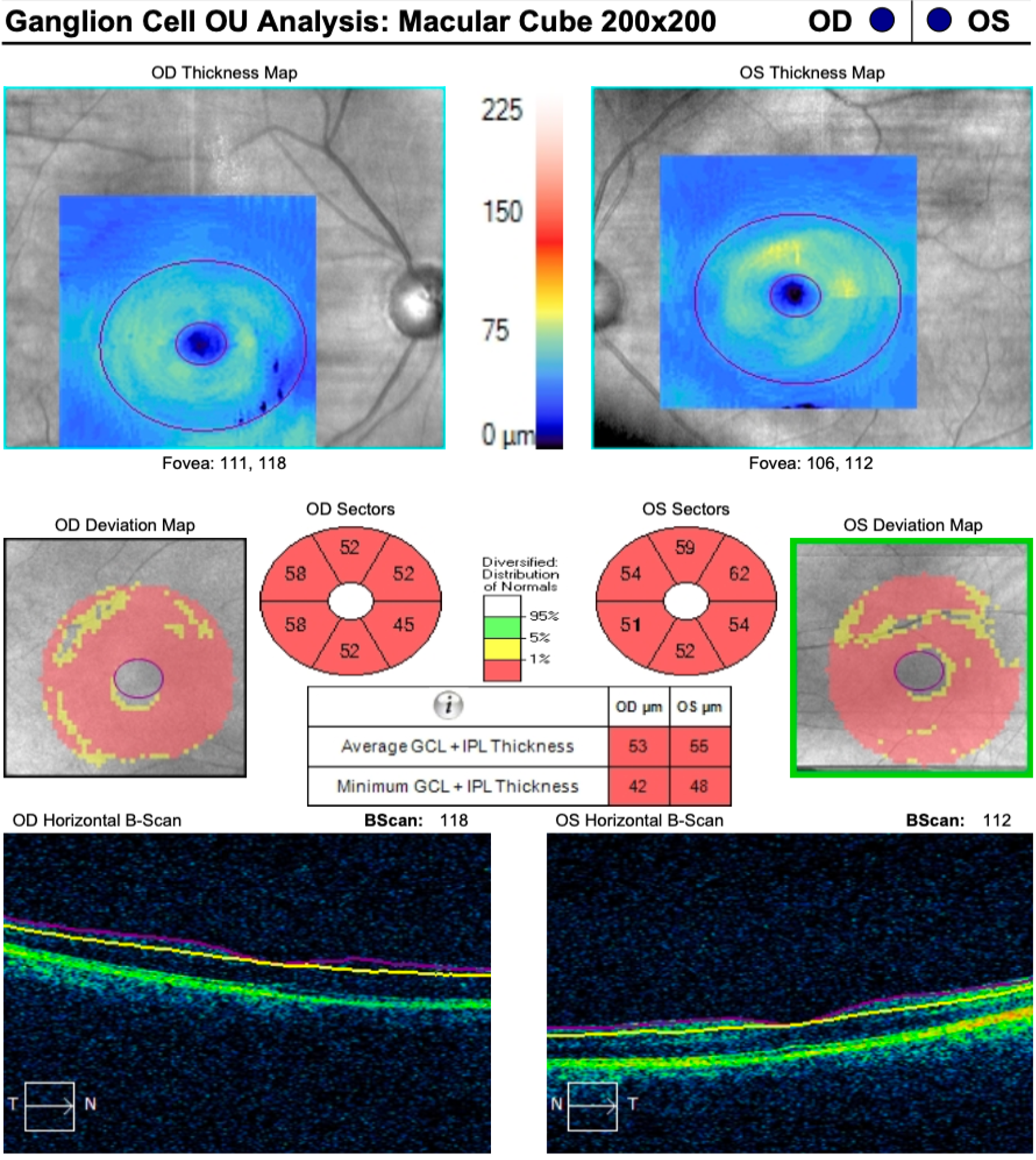 Optical coherence tomography (OCT) of the optic nerve head showing severe dropout of the ganglion cell complex (GCC) in both eyes. Average GCL thickness was 53 μm OD and 55 μm OS. 
