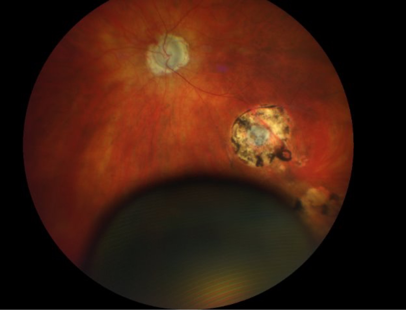 This is a fundus photo of the left eye showing clear media, diffusely pallid disc, a chorioretinal scar along the inferotemporal arcades near the equator, and a large bulbous mass in the inferior quadrant. 