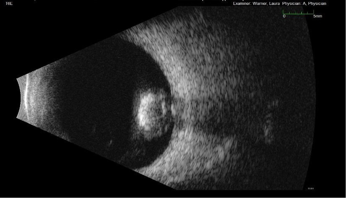 Fluorescein angiography of the left eye at 47 seconds showing nonperfusion from BRAO within the superior aspect of the macula with multiple foci of segmental arterial wall hyperfluorescence superior to the disc and along the inferior arcade.