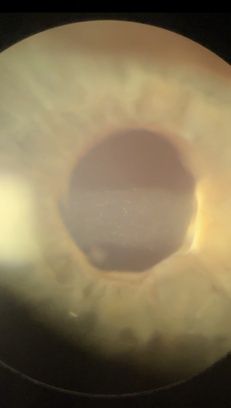 On slit lamp exam, Cell and flare is visible in the left anterior chamber, and the lens is not identifiable in the posterior chamber. 
