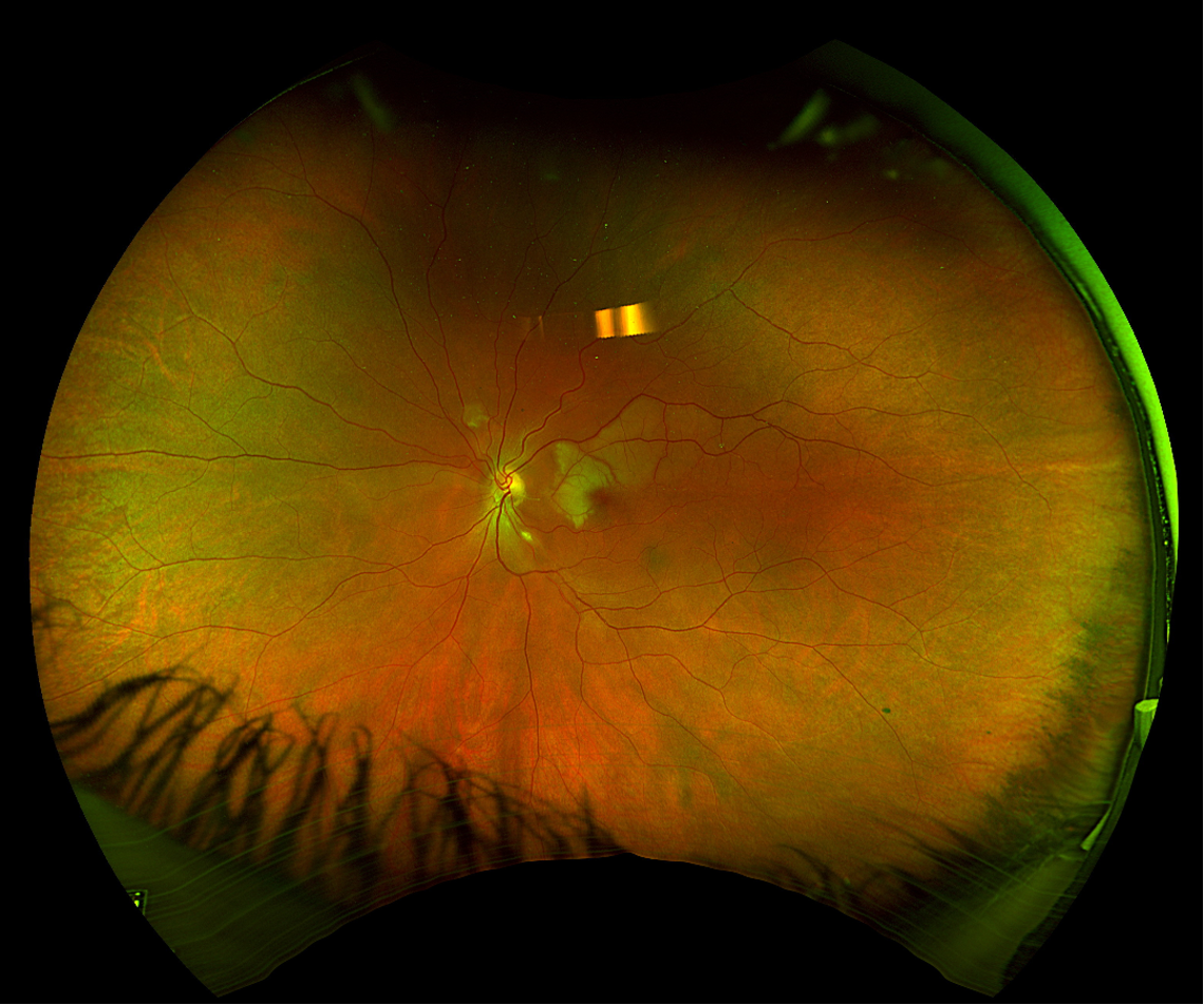 Optos ultra-widefield pseudo-color image of the left eye demonstrating BRAO involving superior half of the macula, a Gass plaque visible within the cilioretinal artery, a twig BRAO superonasal to the disc, and a CWS along the inferotemporal arcade.