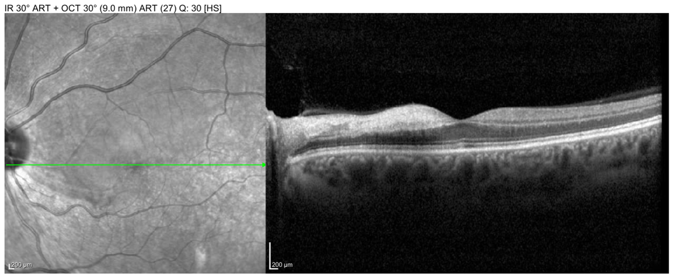 Macula OCT of the left eye showing large BRAO in the macula with inner-retinal edema and hyperreflectivity.