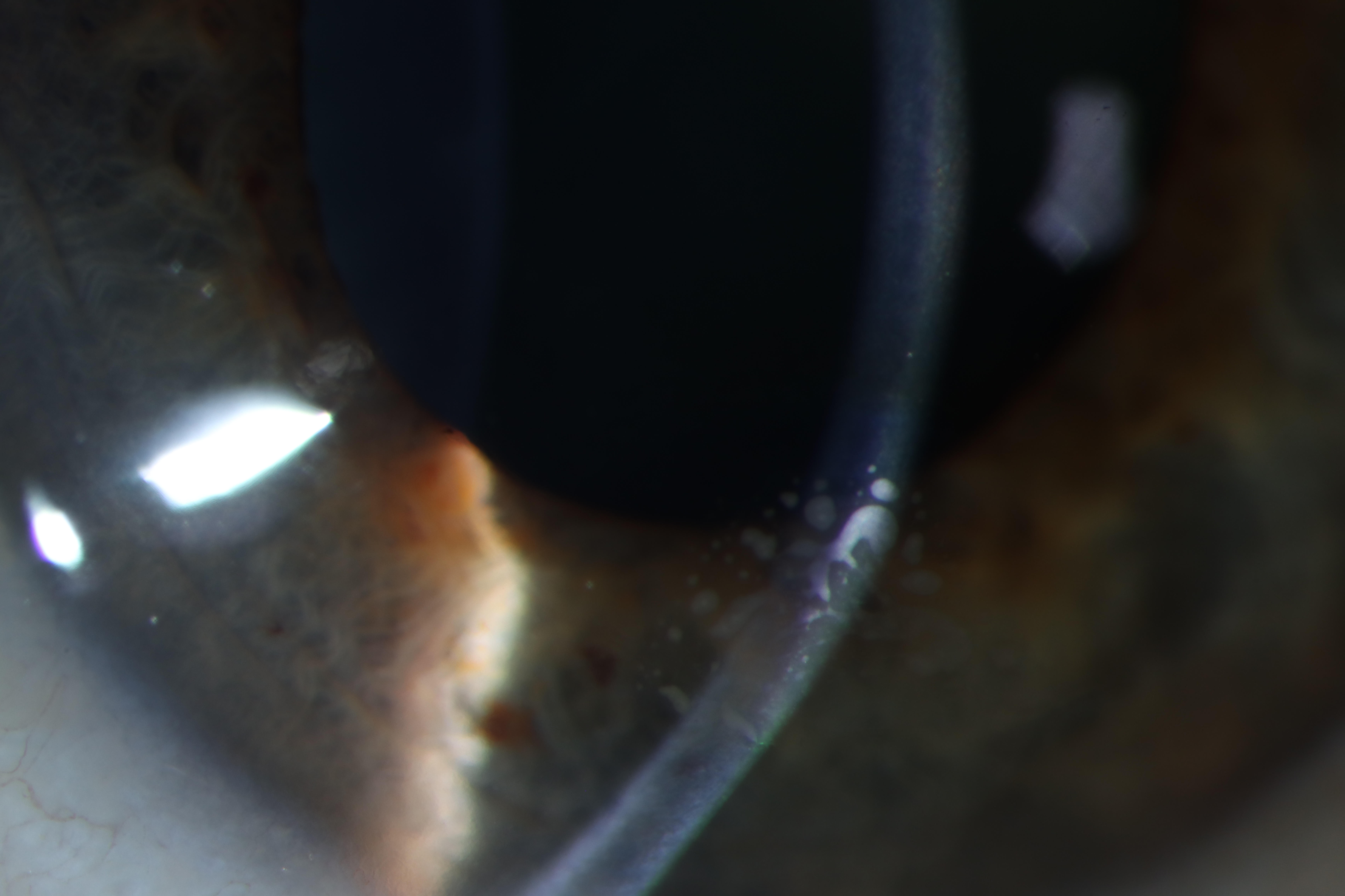 Direct slit beam photograph demonstrating epithelial ingrowth under the LASIK flap.