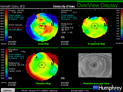 Topographic and Placido images, OS, 4 months after DLEK with IOL exchange