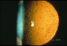 Corneal stromal dystrophies: Macular, Granular, Lattice dystrophy of cornea