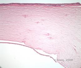 Corneal stromal dystrophies: Macular, Granular, Lattice dystrophy of cornea