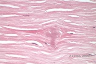 Corneal stromal dystrophies: Macular, Granular, Lattice dystrophy of cornea