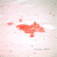 Corneal stromal dystrophies: Macular, Granular, Lattice dystrophy of cornea