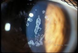 Corneal stromal dystrophies: Macular, Granular, Lattice dystrophy of cornea