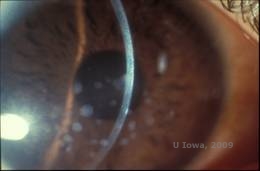 Corneal stromal dystrophies: Macular, Granular, Lattice dystrophy of cornea