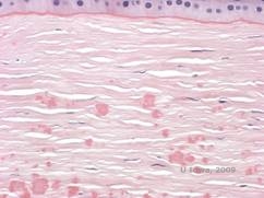 Corneal stromal dystrophies: Macular, Granular, Lattice dystrophy of cornea