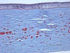 Corneal stromal dystrophies: Macular, Granular, Lattice dystrophy of cornea