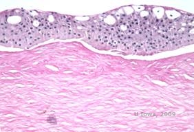 Corneal stromal dystrophies: Macular, Granular, Lattice dystrophy of cornea