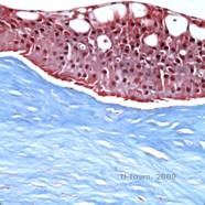 Corneal stromal dystrophies: Macular, Granular, Lattice dystrophy of cornea