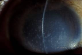 Corneal stromal dystrophies: Macular, Granular, Lattice dystrophy of cornea