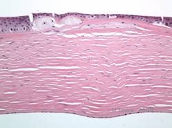 Corneal stromal dystrophies: Macular, Granular, Lattice dystrophy of cornea