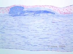 Corneal stromal dystrophies: Macular, Granular, Lattice dystrophy of cornea