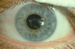 Corneal stromal dystrophies: Macular, Granular, Lattice dystrophy of cornea