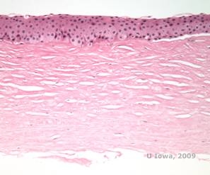 Corneal stromal dystrophies: Macular, Granular, Lattice dystrophy of cornea