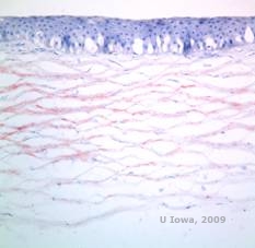 Corneal stromal dystrophies: Macular, Granular, Lattice dystrophy of cornea