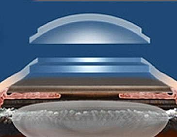Top Hat Shaped Corneal Graft