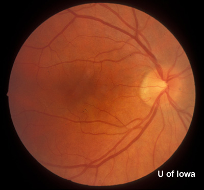 fundus, right eye