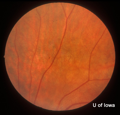 Peripheral fundus, left eyte