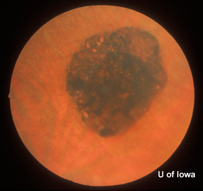 CHRPE in peripheral fundus of left eye