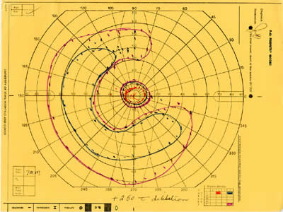 Goldmann visual field, left eye, revealed a ring scotoma of mid-peripheral field loss with preserved central and temporal visual field. Visual field in the right eye was normal